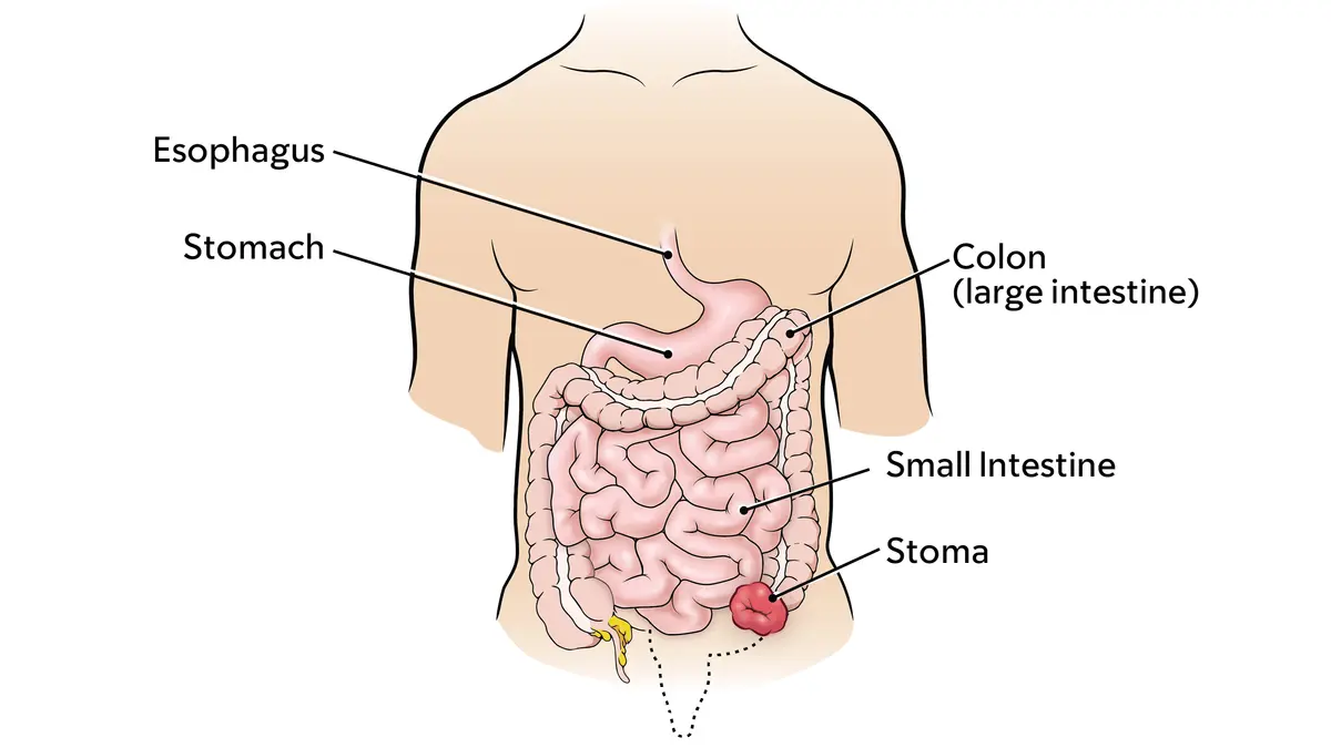 Colostomy stoma shown with the rest of the digestive system, the esophagus, stomach, large, and small intestine. 