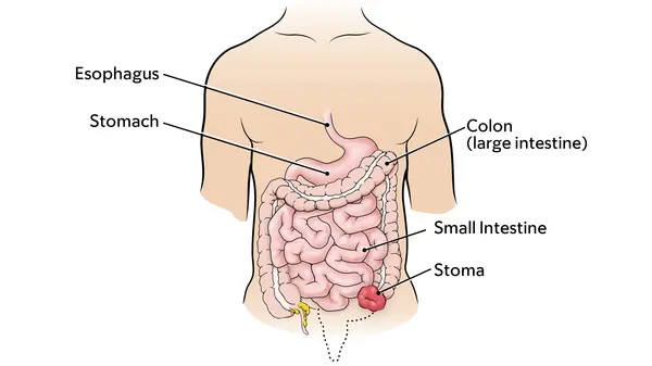 Diagram of the colon, intestine, stomach, and a colostomy stoma 